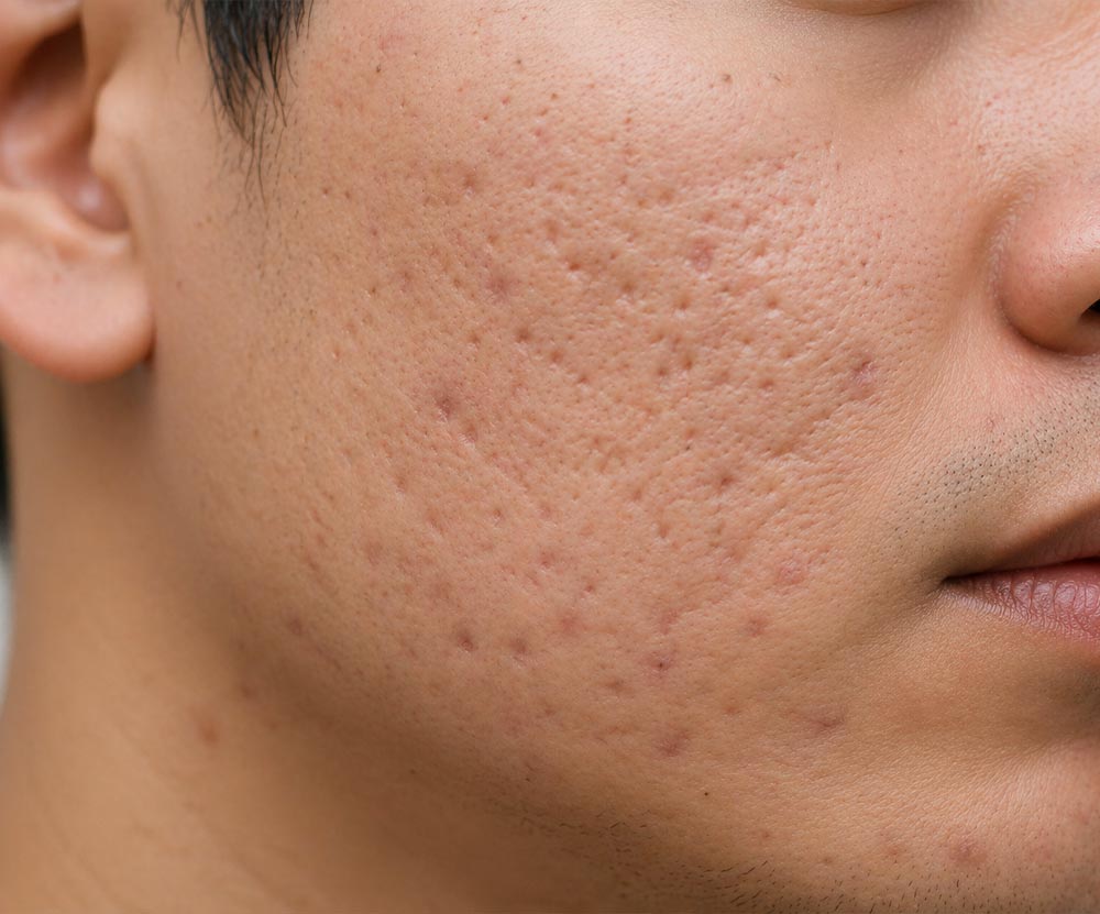 Acne-Scar-Home-Photo