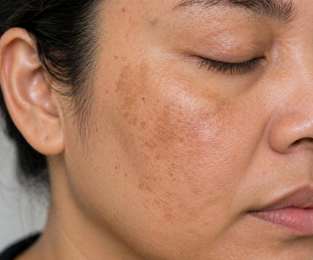 Melasma-Home-Picture