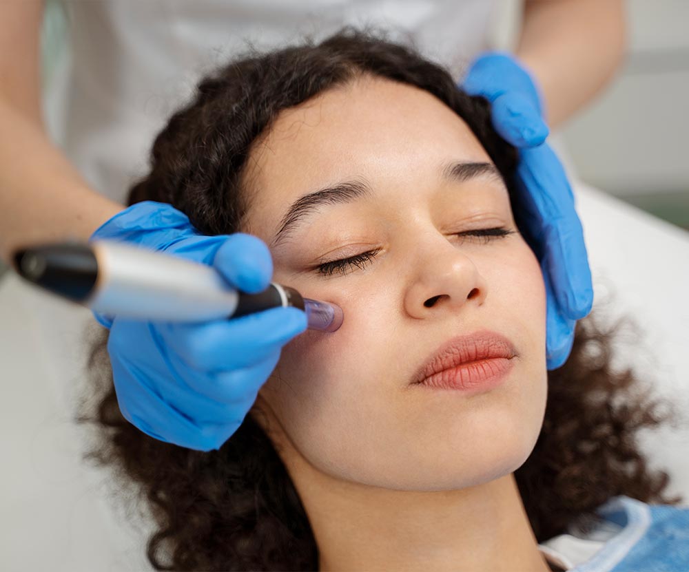 RF-Microneedling-Home
