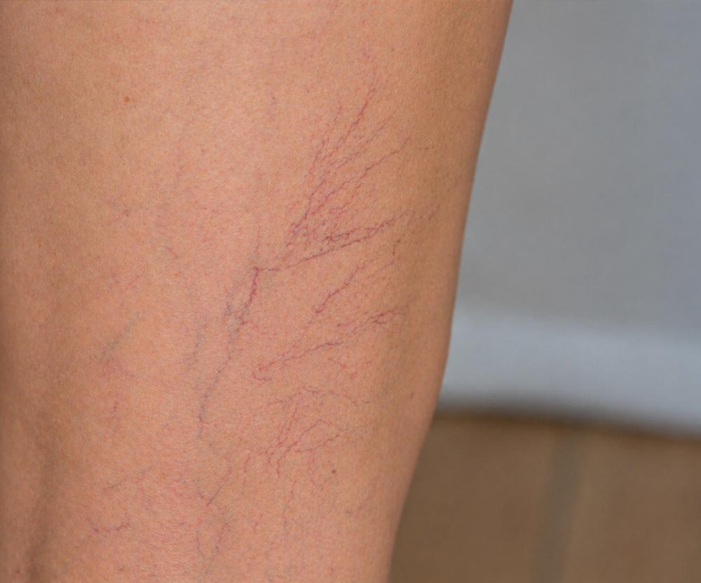 Spider-Veins-Home