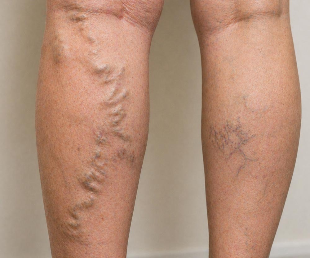 Varicose-Veins-Home