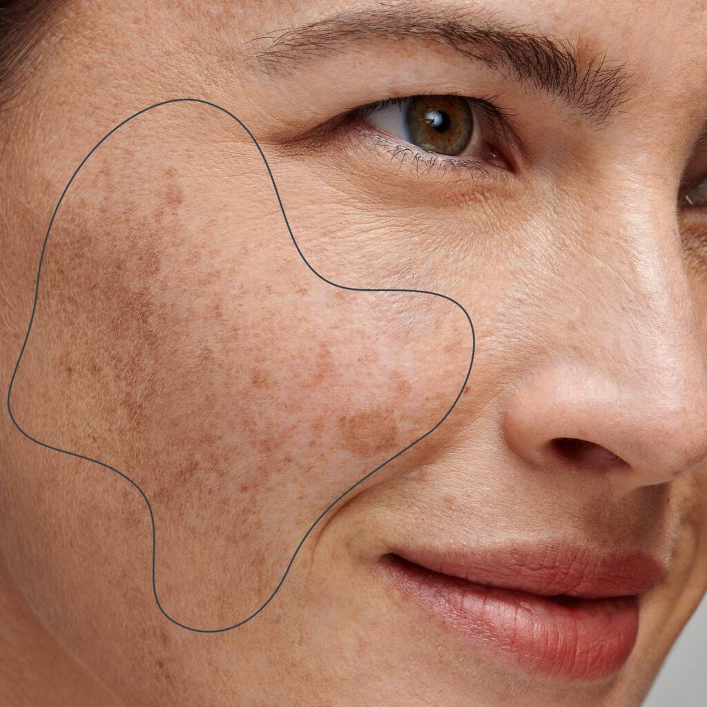 Pigmentation