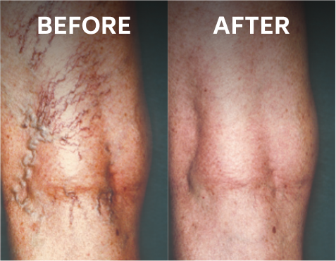 Sclerotherapy